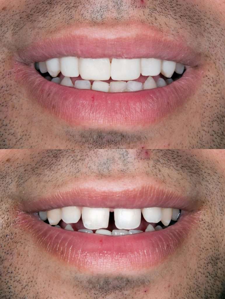 dental veneers ballarat-alternative-orthodontics-771x1024